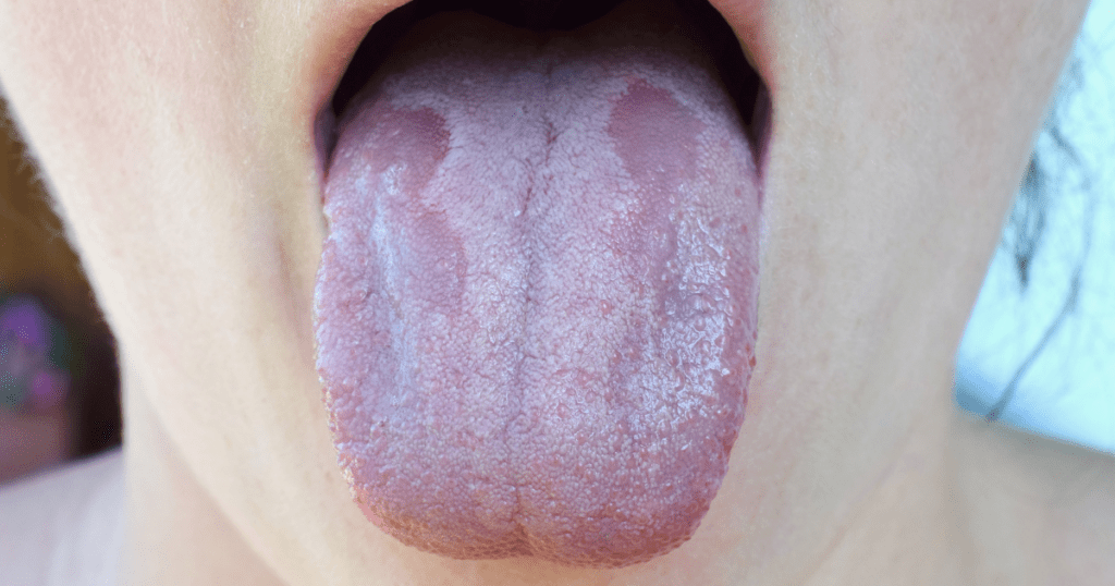 candidiasis oral