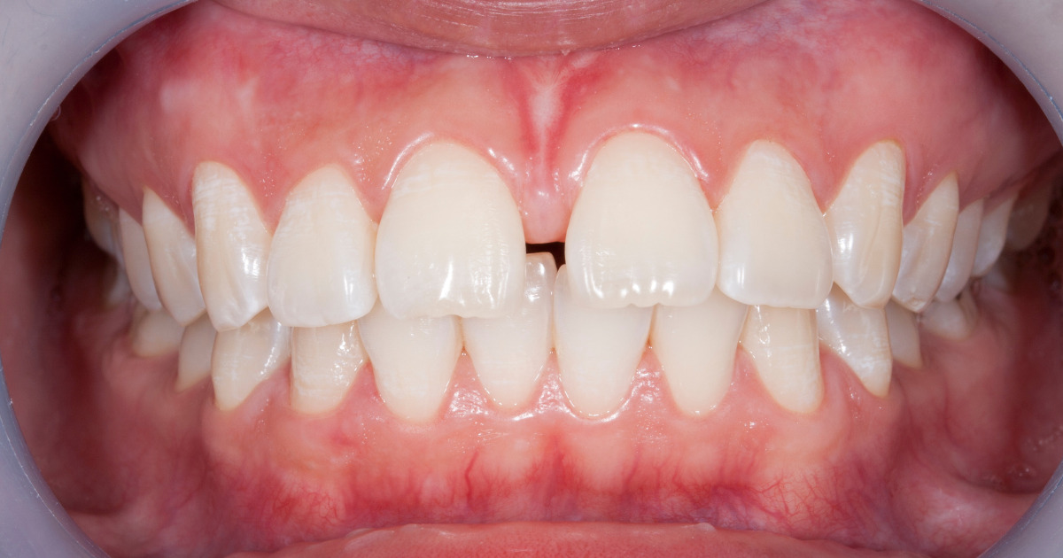 Espacios entre los dientes