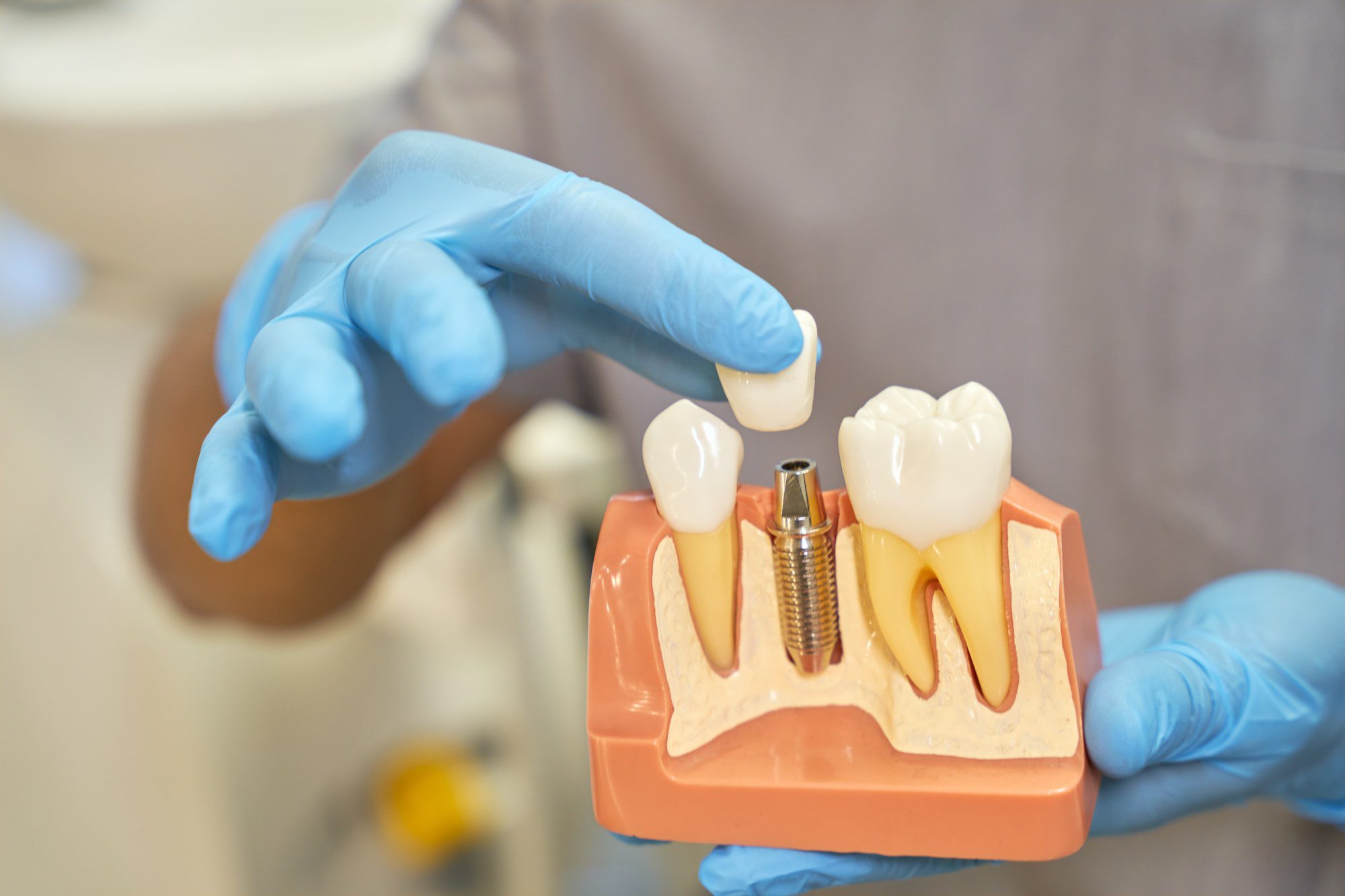 implantes dentales tradicionales y de carga inmediata